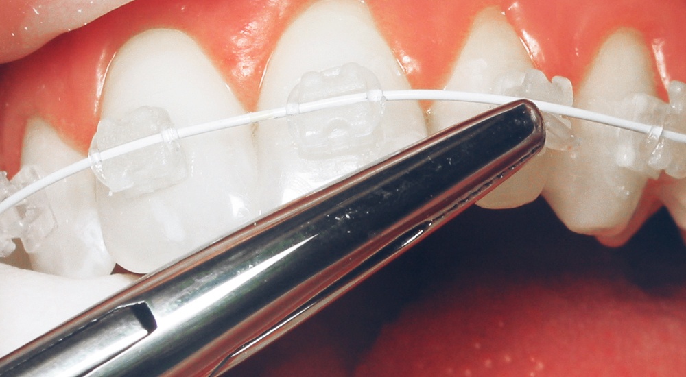 Dental CE Ortho Courses for General Dentist Six Month Smiles